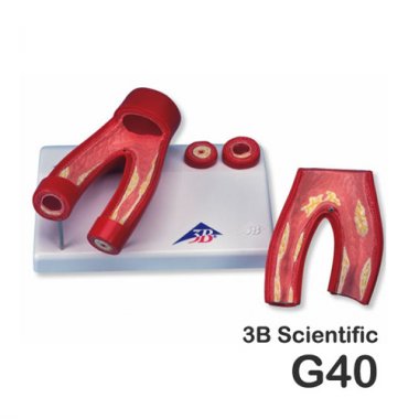 [3B]동맥경화모형<br>G40