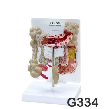 [GPI]대장질환모형<br>G334